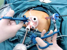 極致微創(chuàng)手術助91歲婆婆快速告別腸癌  第2張