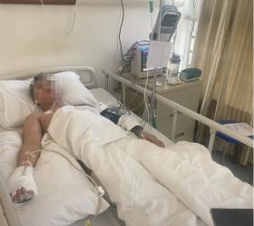 24歲小伙上班6天誤觸輻射源，手指不斷腐爛面臨截肢；當(dāng)事小伙：我付出了慘痛代價，希望大家引以為戒  第2張